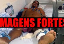 ÚLCERA: portovelhense que está em estado crítico de saúde pede ajuda para custear tratamento