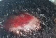 Desentendimento entre irmãos termina em tentativa de assassinato com paulada na cabeça em distrito de Corumbiara