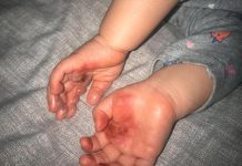 Após acidente com forno de casa, vilhenense alerta mães sobre risco de queimaduras em bebês