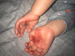 Após acidente com forno de casa, vilhenense alerta mães sobre risco de queimaduras em bebês