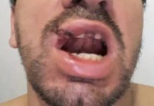 Homem tem dentes quebrados ao ser agredido a socos em distrito de Cabixi