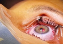 Fiscalização do Cremero confirma surto de infecção pós mutirão de cirurgias oftalmológicas